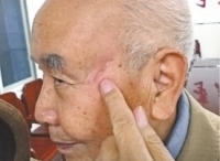 志愿军老兵回忆长津湖血战：冻伤双腿，脑内弹片68年后取出
